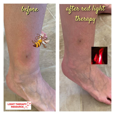 Using Red Light Therapy for Treating Injuries Like Bee Stings